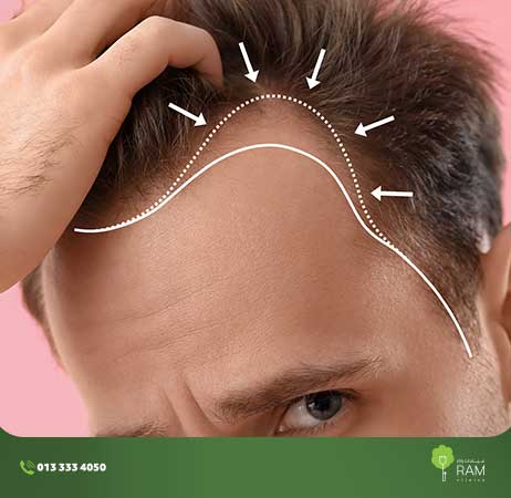 Hair Loss and Genetic Baldness Treatment at Ram Clinics