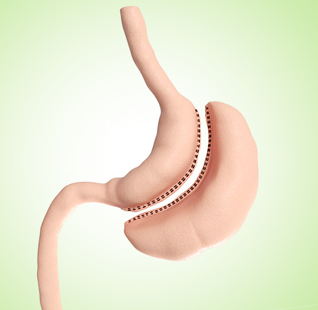 Gastric sleeve