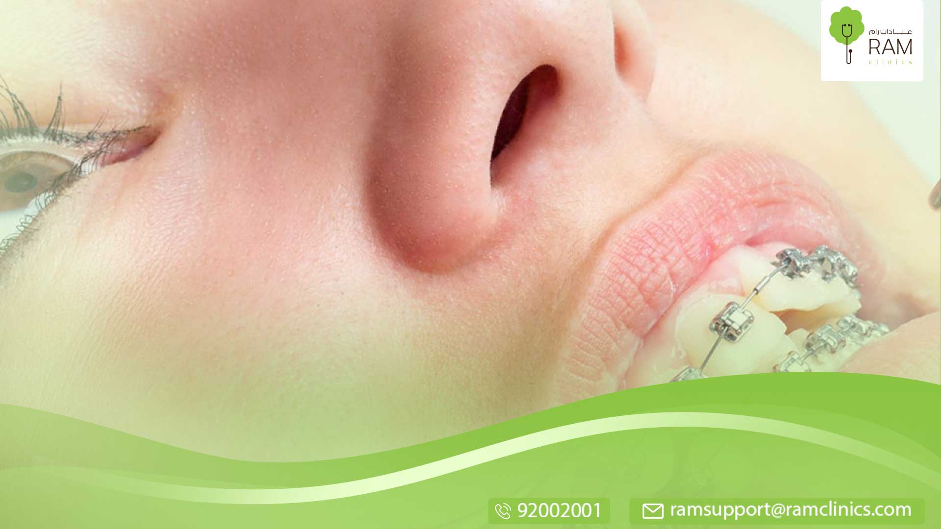 تقويم الاسنان