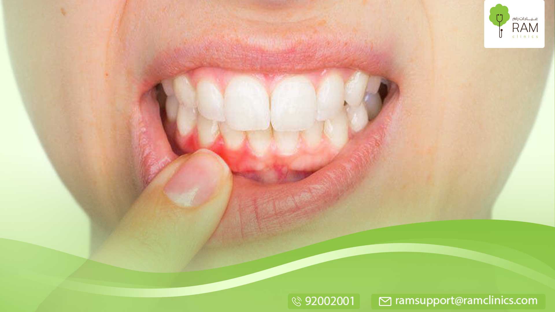 التهاب اللثة