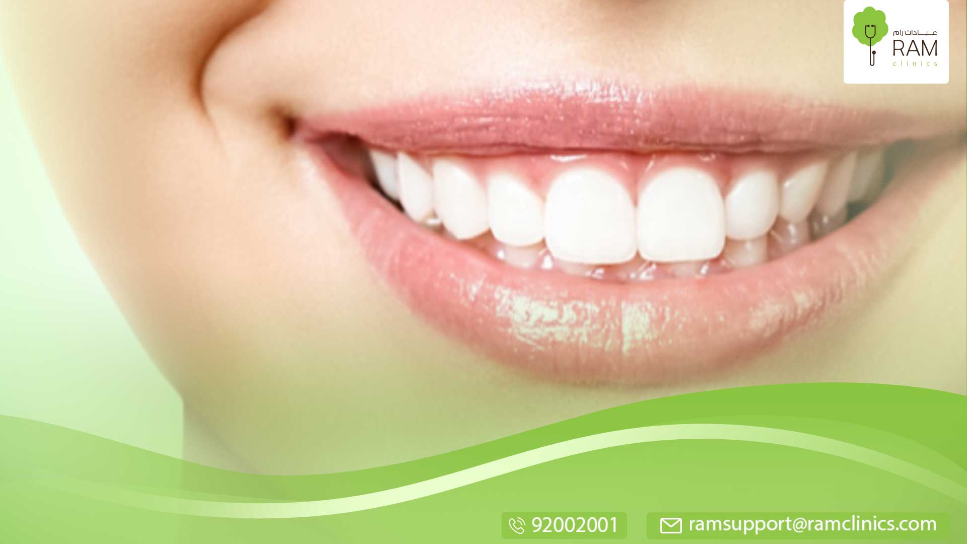 ابتسامة هوليوود