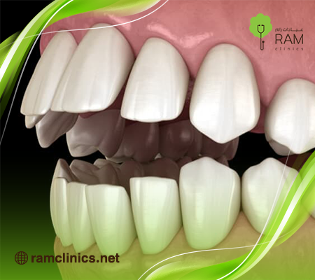 تطابق الاسنان