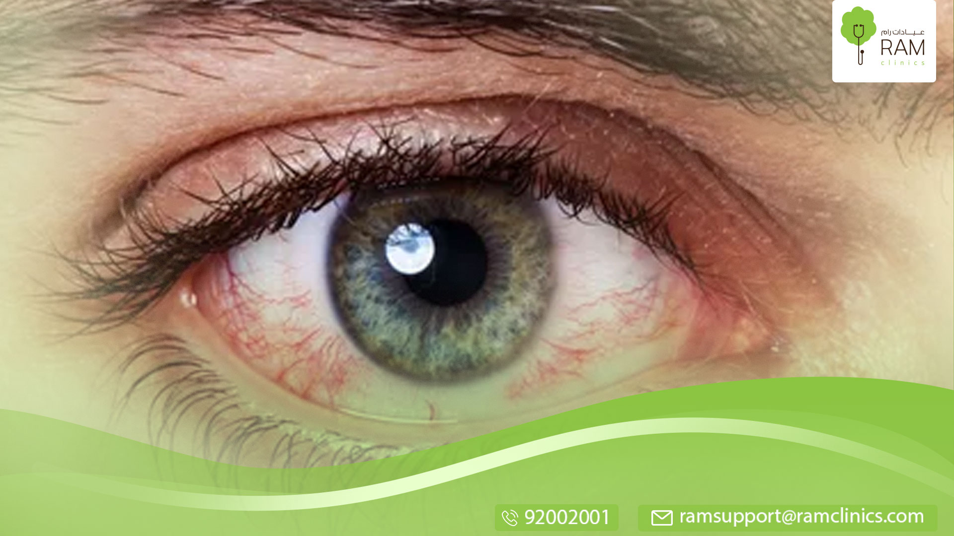 حساسية العين