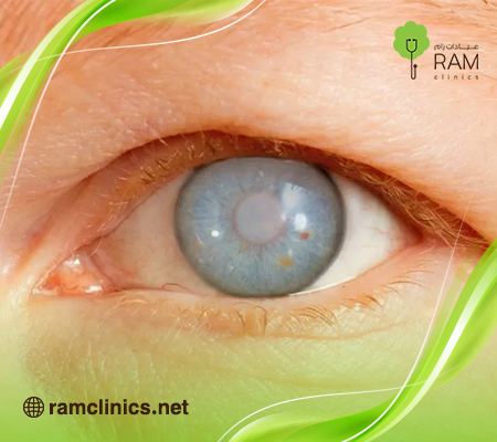 الماء الأزرق في العين