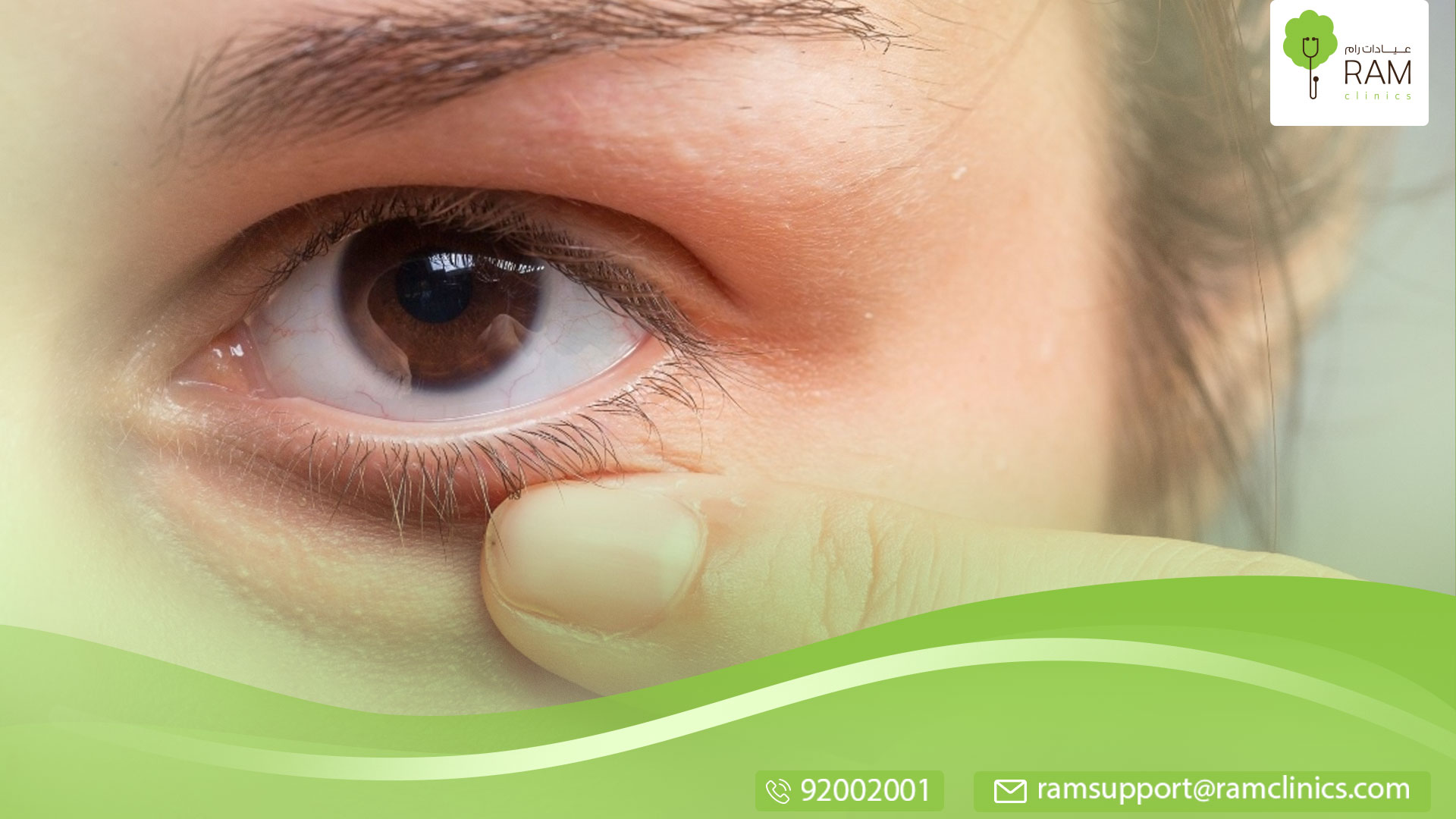 الماء الأبيض في العين