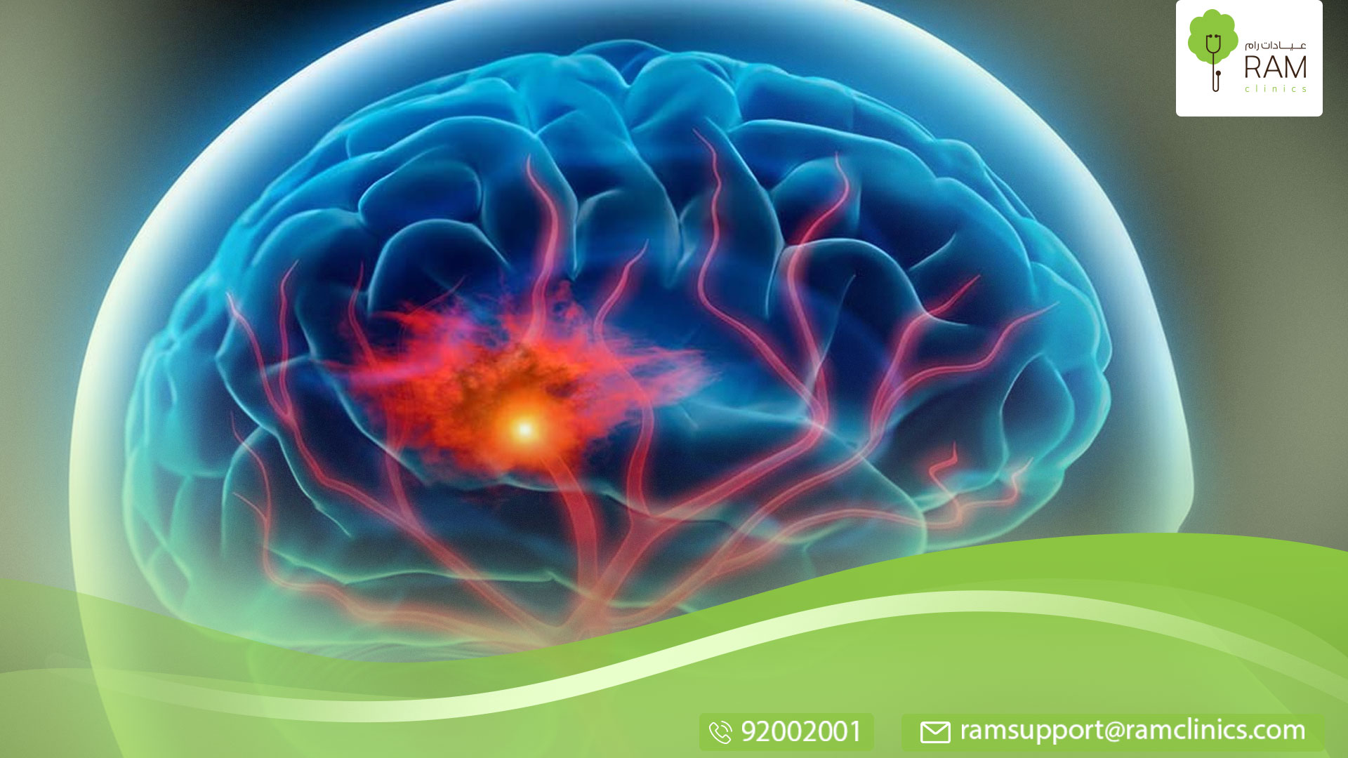 السكتة الدماغية