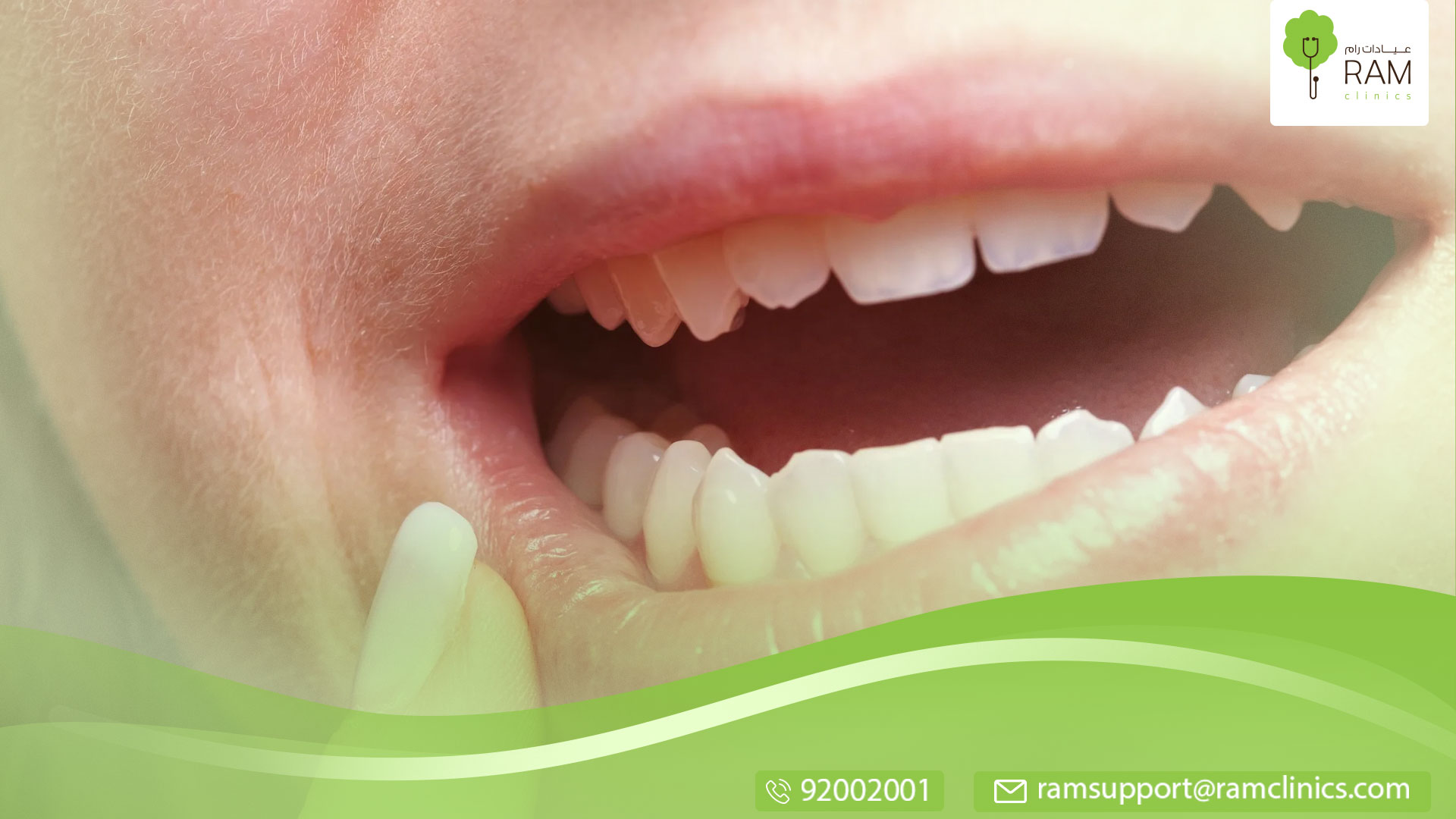 التهاب العصب