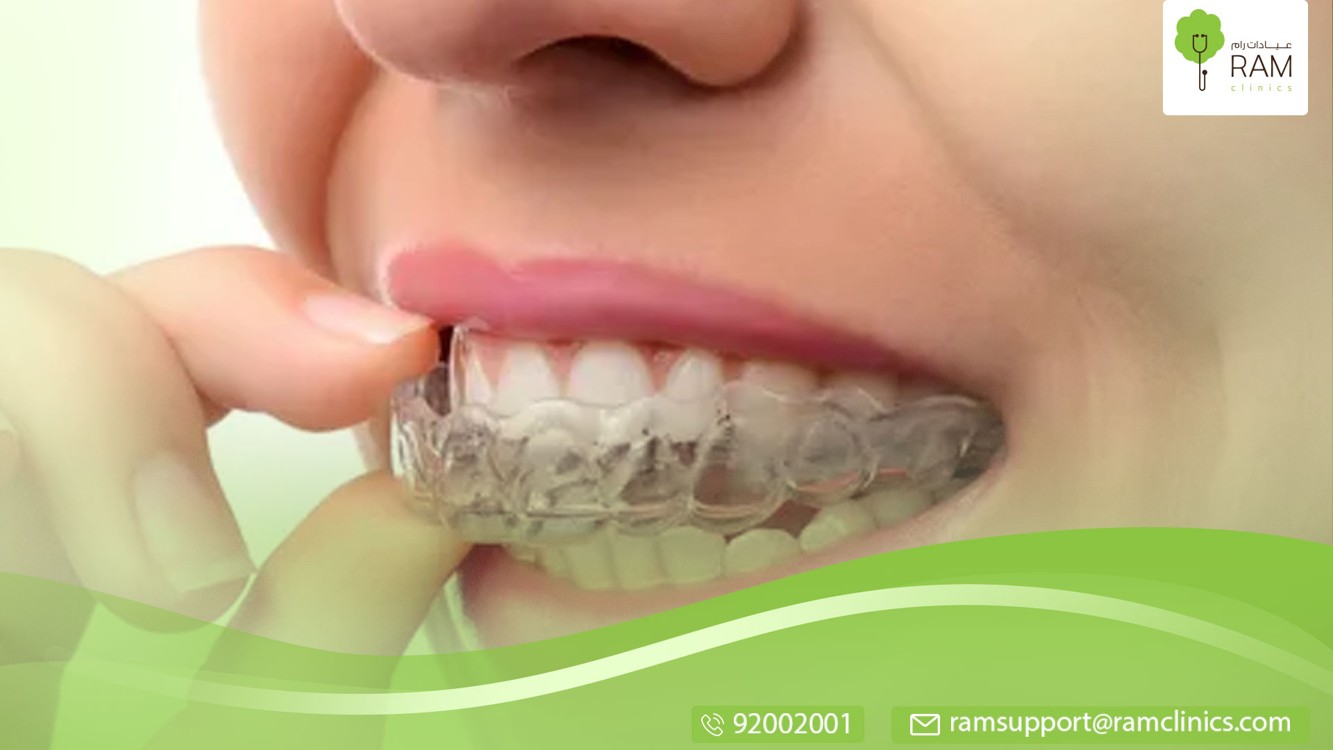 تقويم الاسنان الشفاف