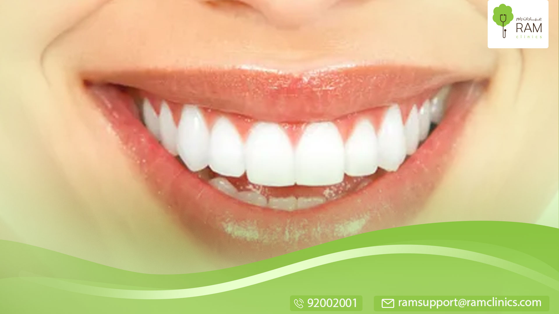 خطوط الابتسامة