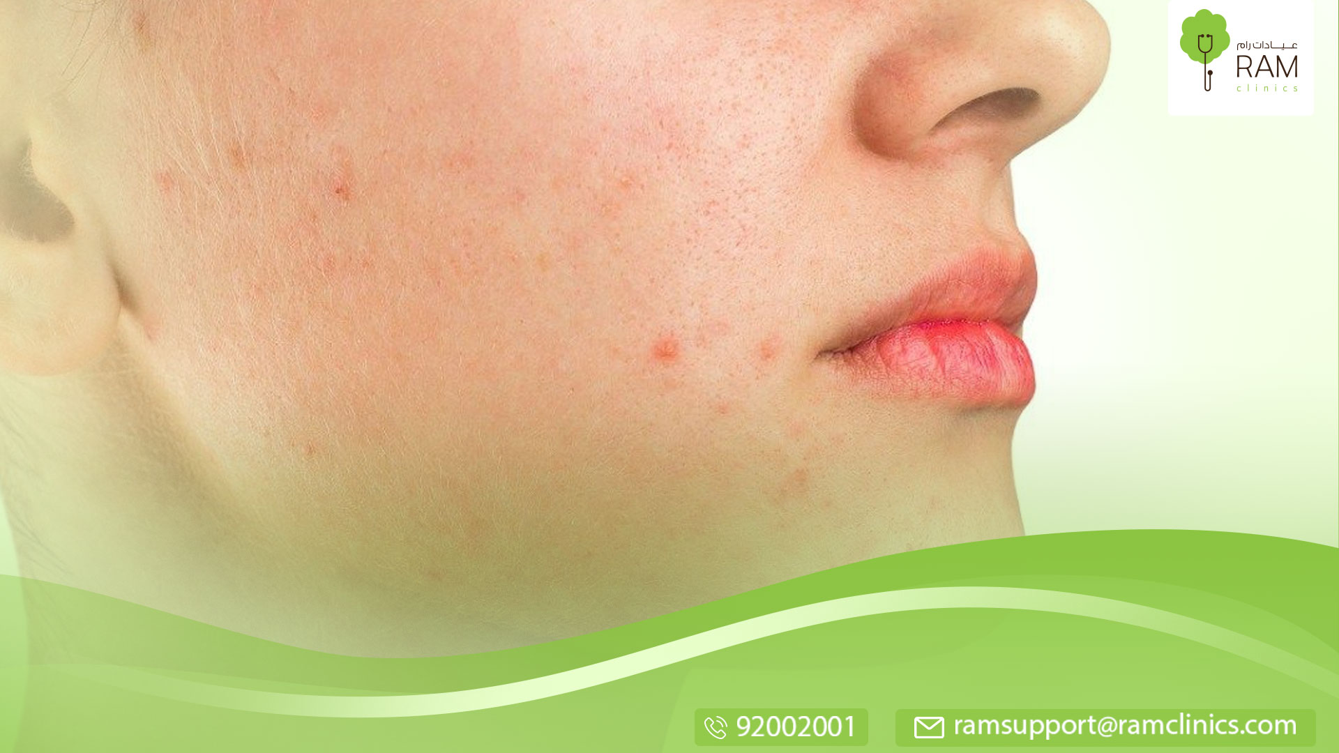 كيف تتكون الشامة