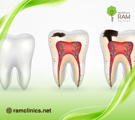 تسوس الاسنان
