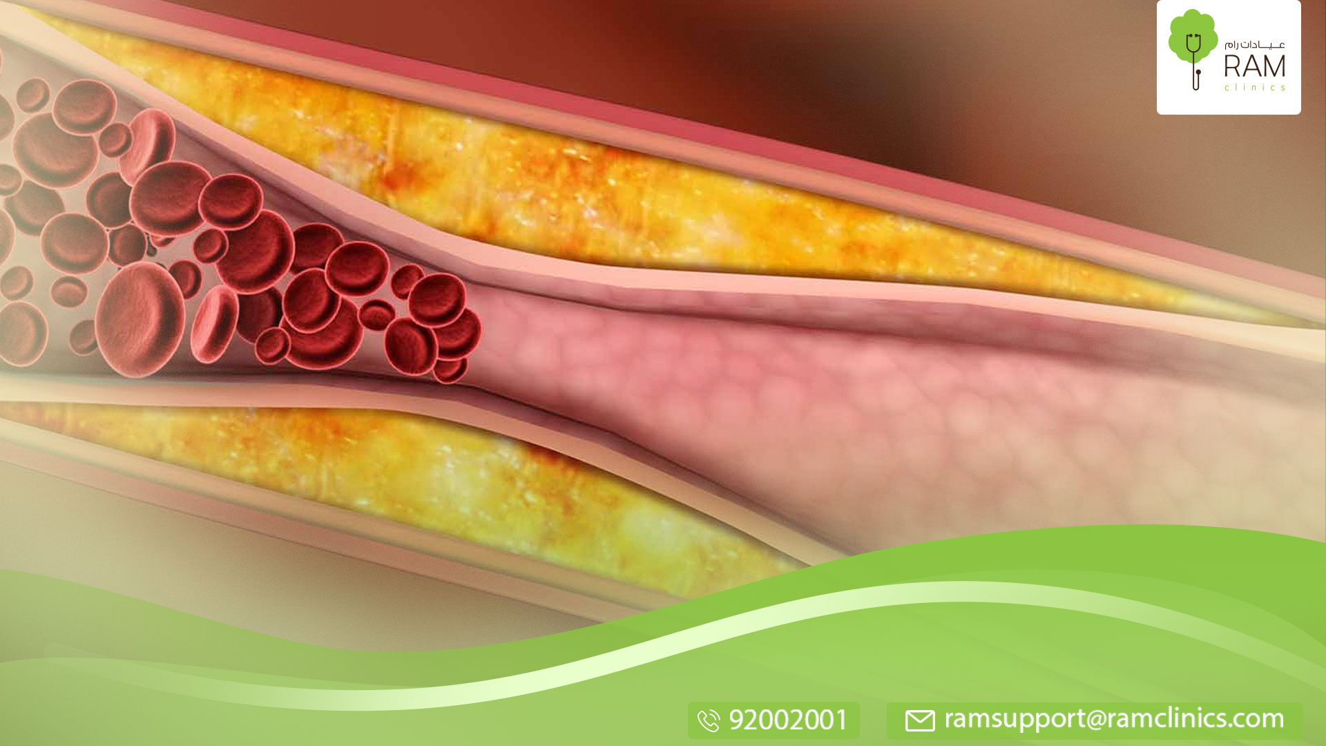 مرض الكولسترول