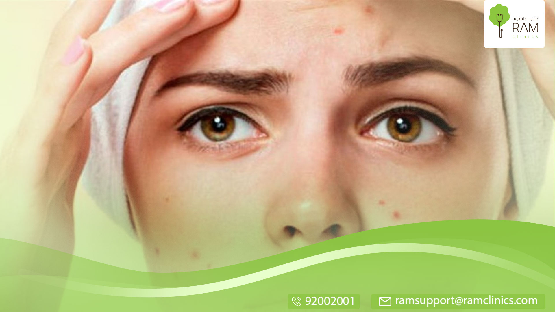 اسباب حب الشباب