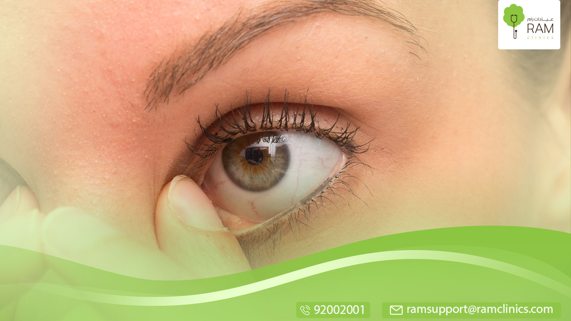 اسباب سواد تحت العين