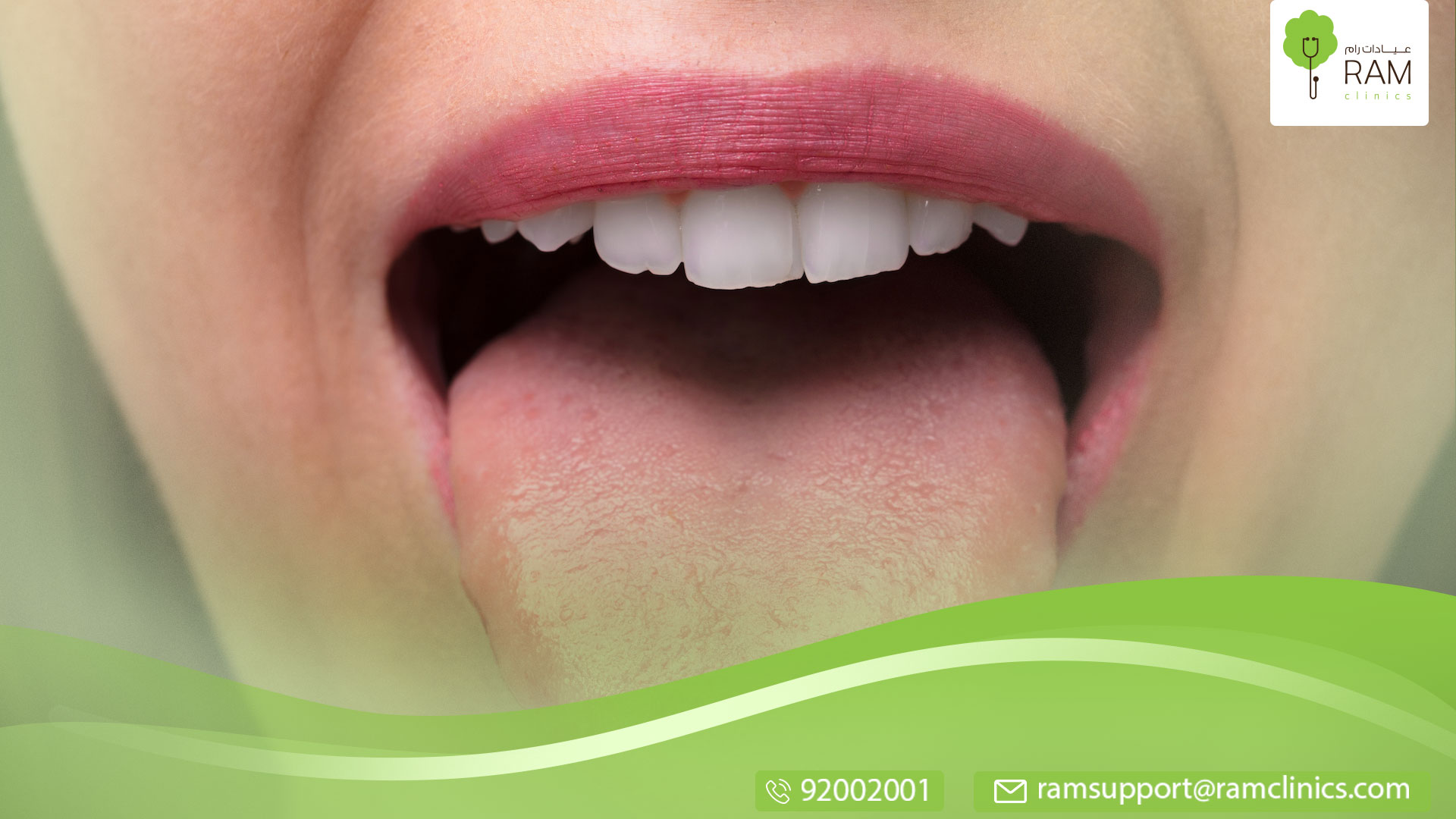 علاج فطريات اللسان