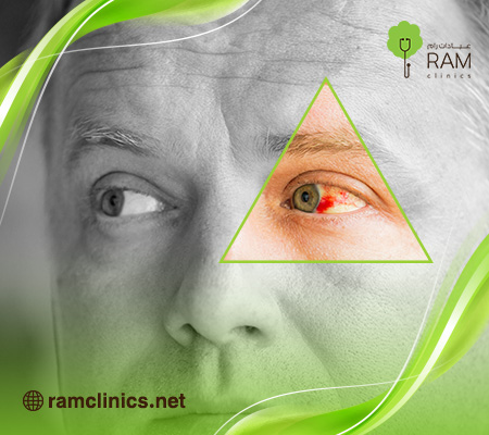 بقع الدم على العين ماهو سببه؟