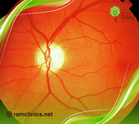 التصلب الجانبي الضموري