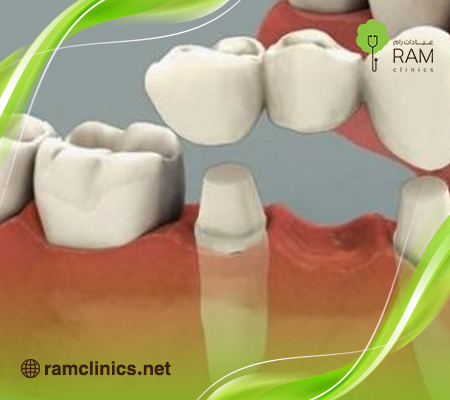 تركيبات الاسنان