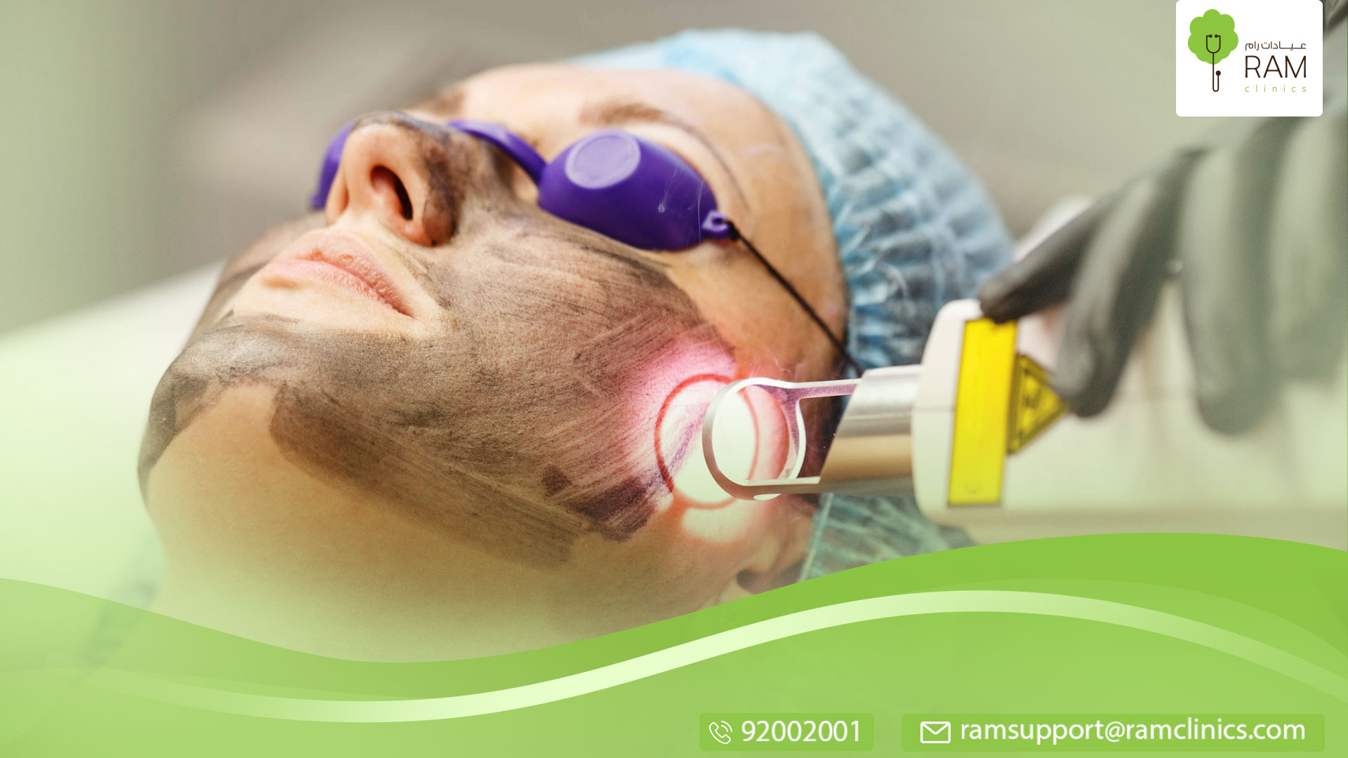 ليزر الكربوني و الفراكشنال