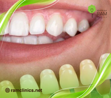 لماذا يتغير لون الأسنان