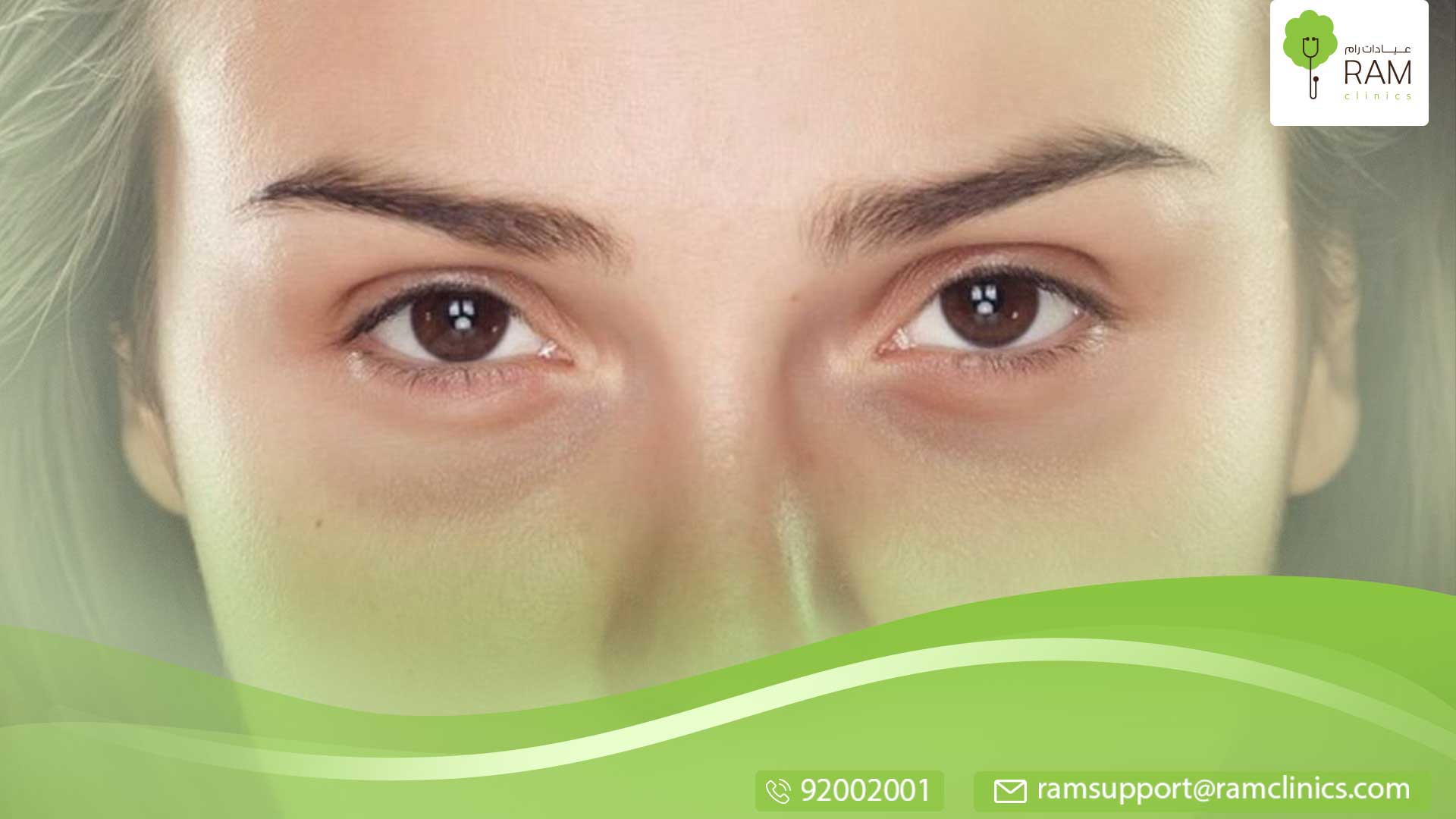 زغللة العين