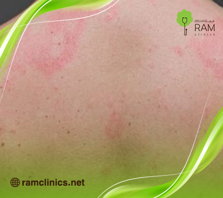 الطفح الحراري