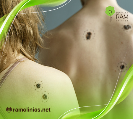 إزالة الثالول بالليزر