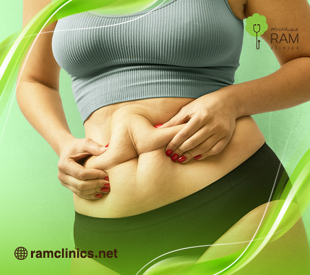 تقنية تجميد الدهون