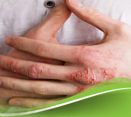 علاج- الاكزيما- نهائيا