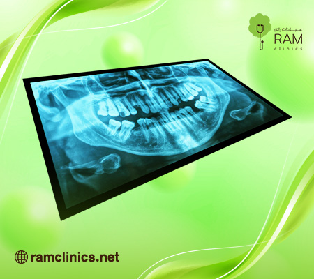 اشعة-بانوراما-للاسنان
