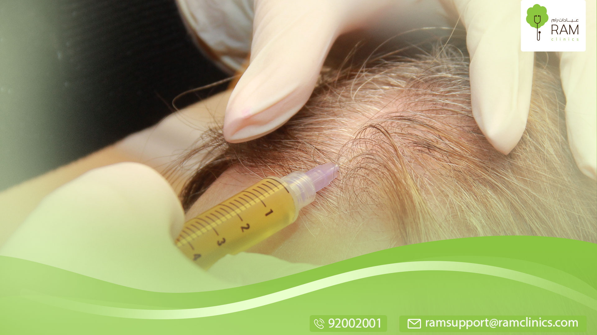 زراعة الشعر للنساء