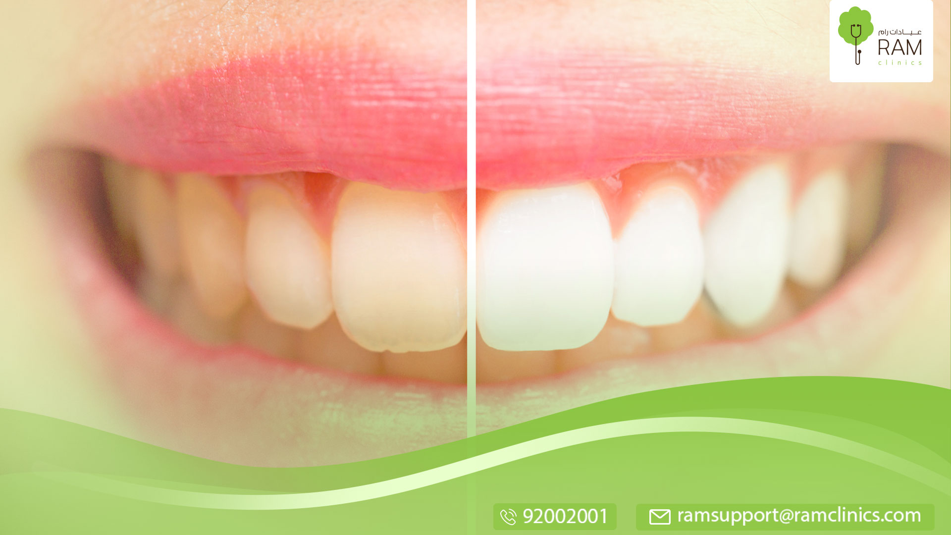 تغير لون الأسنان إلى الرمادي