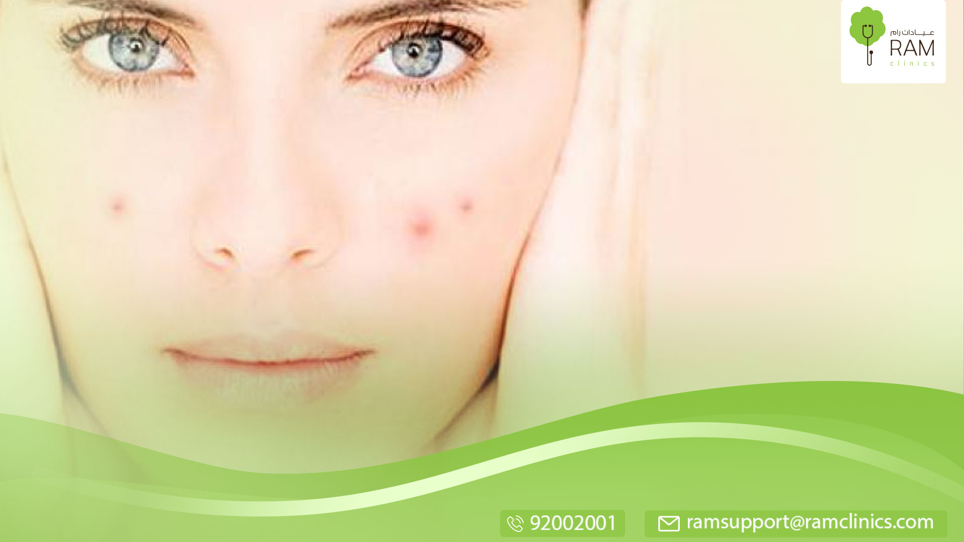 علاج اثار حب الشباب بالليزر