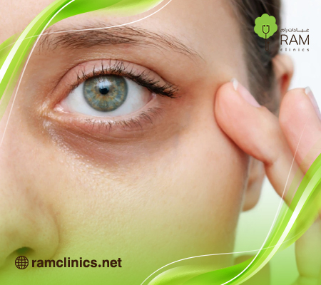 علاج الهالات السوداء تحت العين