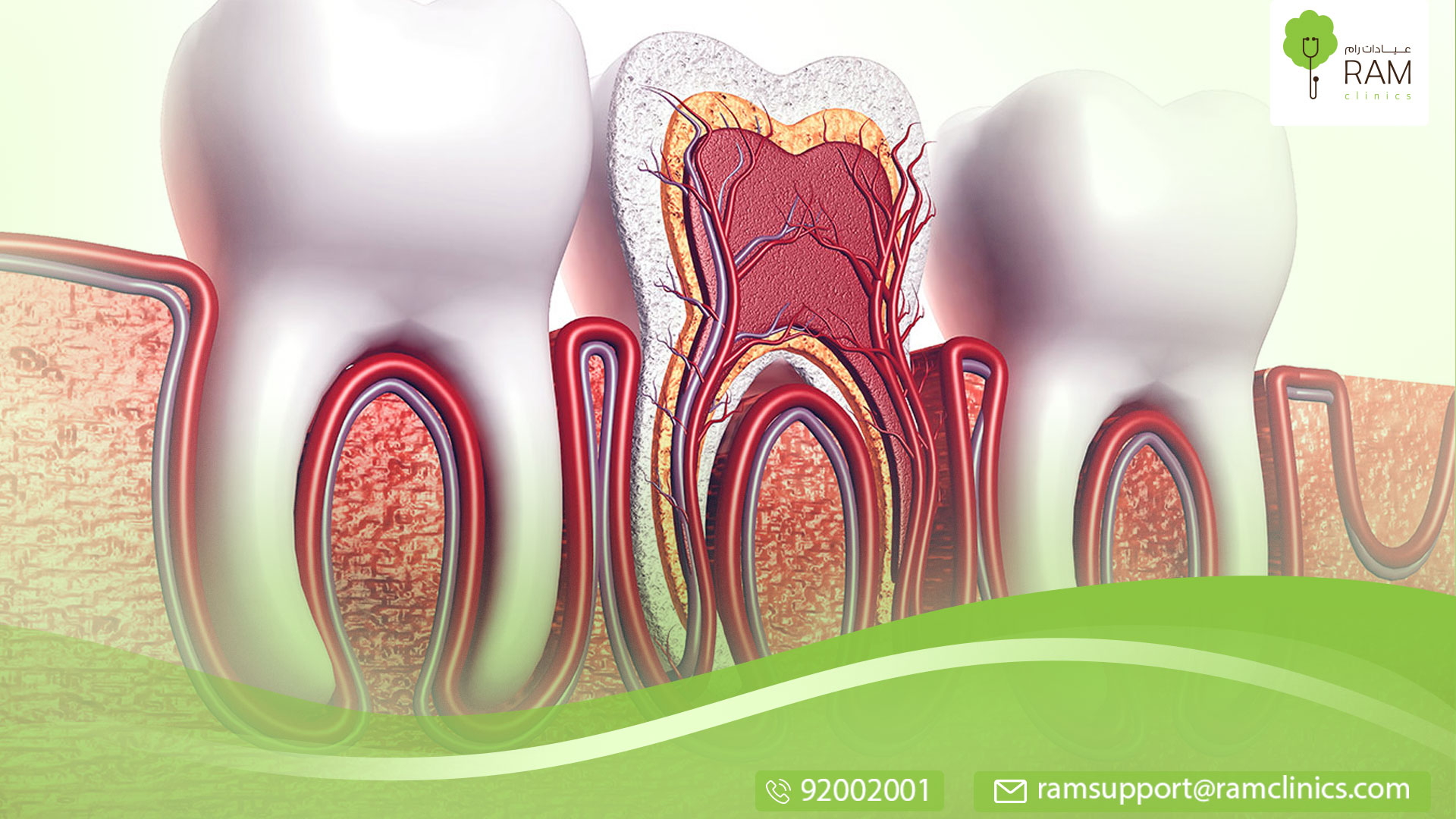 علاج التهاب عصب الأسنان