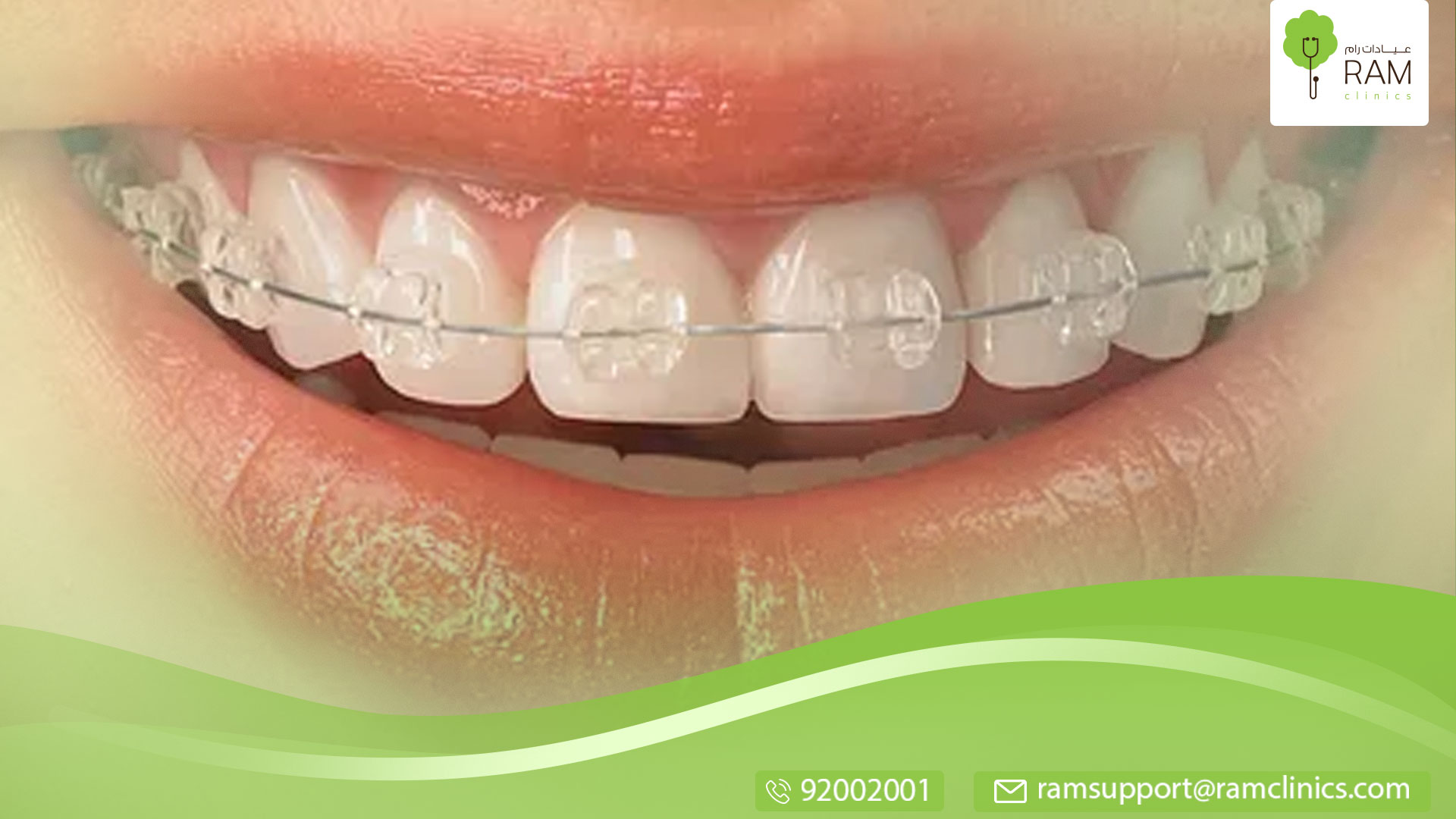 مثبت الأسنان بعد التقويم