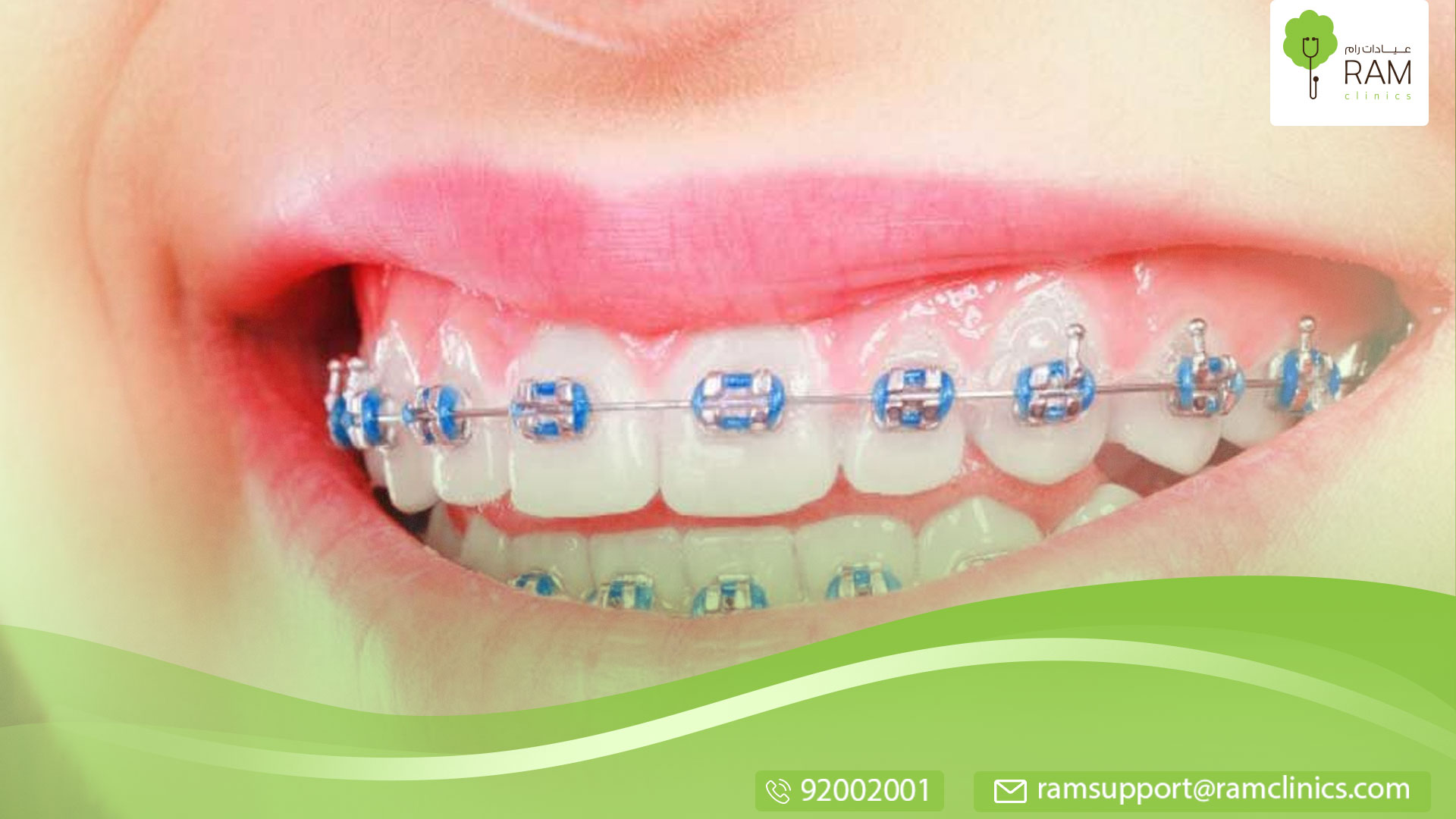 فراغات الأسنان بعد التقويم