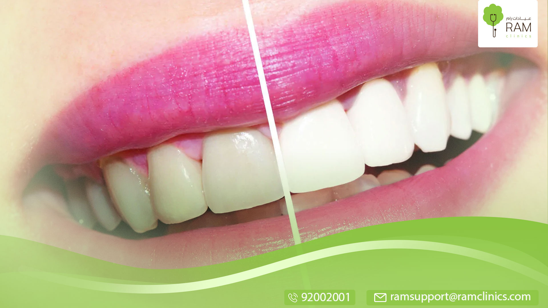 معلومات هامة حول تبييض الأسنان