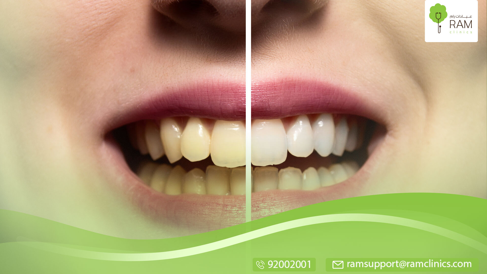 انواع تبييض الأسنان الحديثة