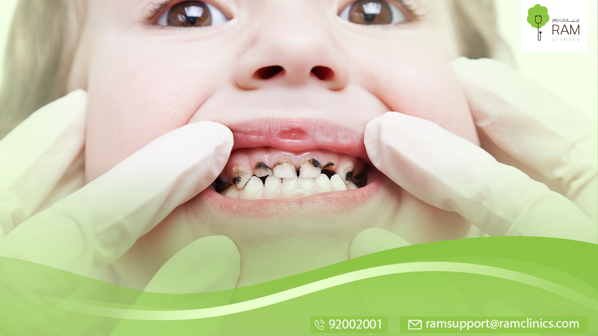 مضاعفات تسوس الأسنان