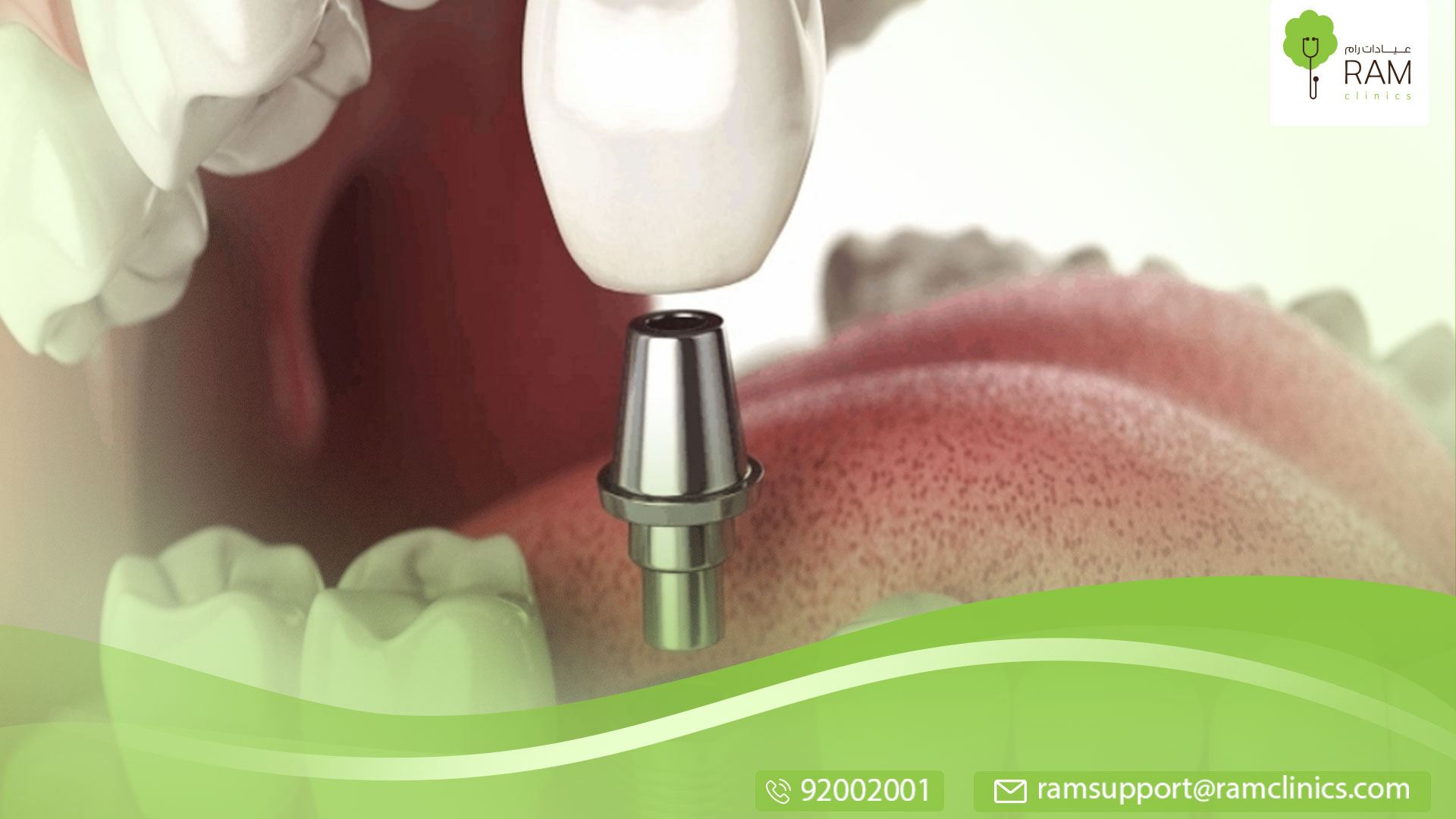 معلومات عن مدة زراعة الأسنان