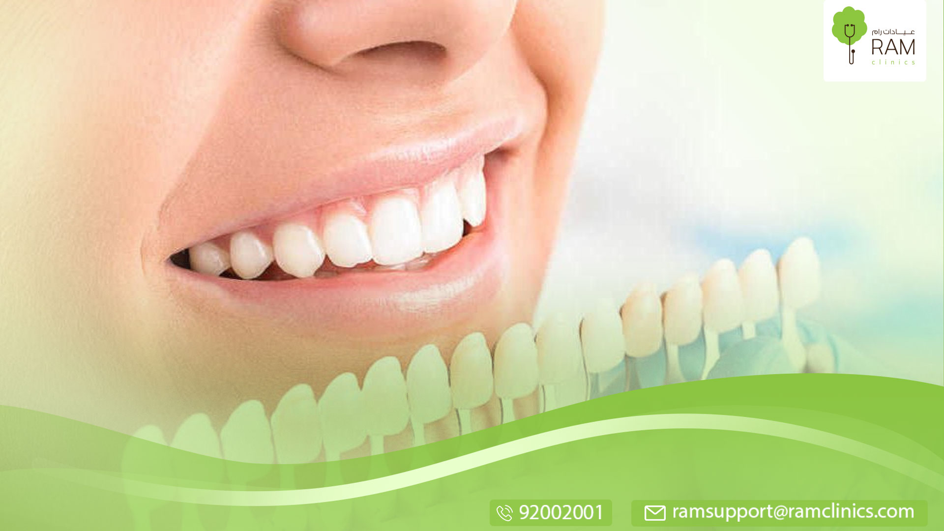 لصقات تبييض الأسنان واهميتها