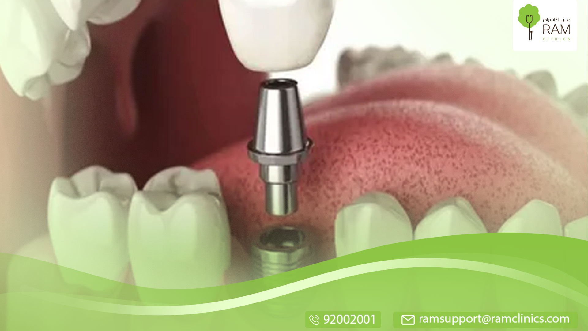 ما هي عملية زراعة لأسنان