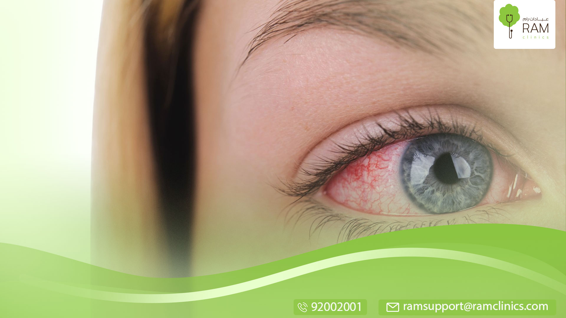 اسباب احمرار العين