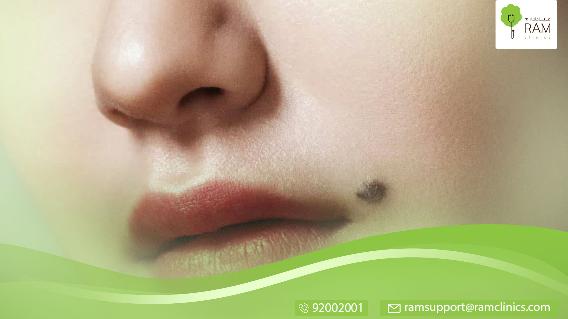 علاج الزوائد الجلدية في الجهاز التناس