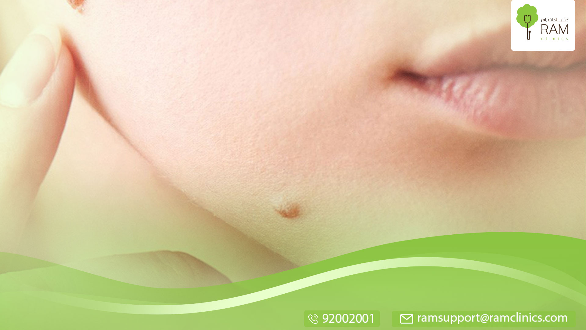 علاج الزوائد الجلدية