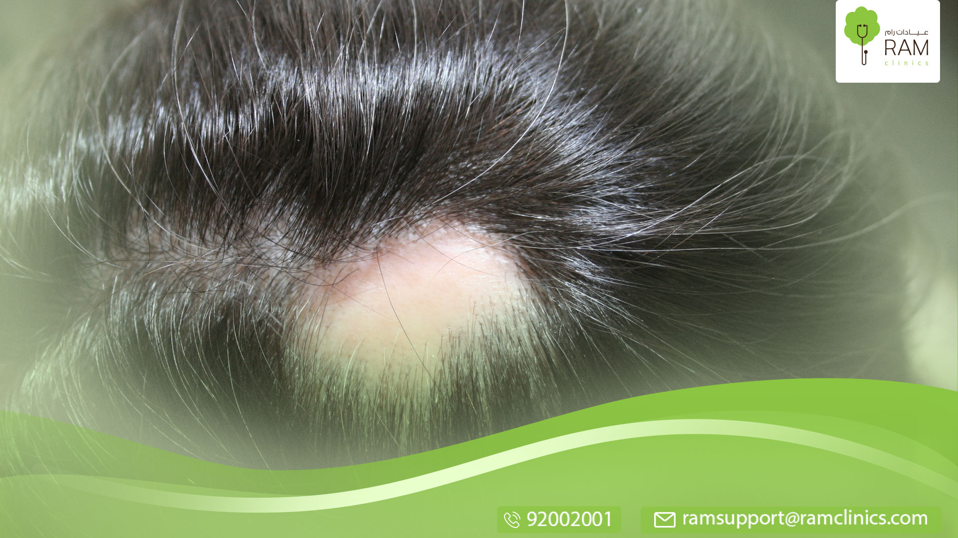 علاج الثعلبة بالأعشاب الطبيعية