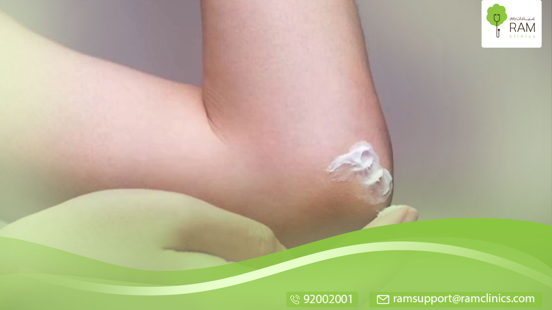 علاج الأكزيما بالأعشاب