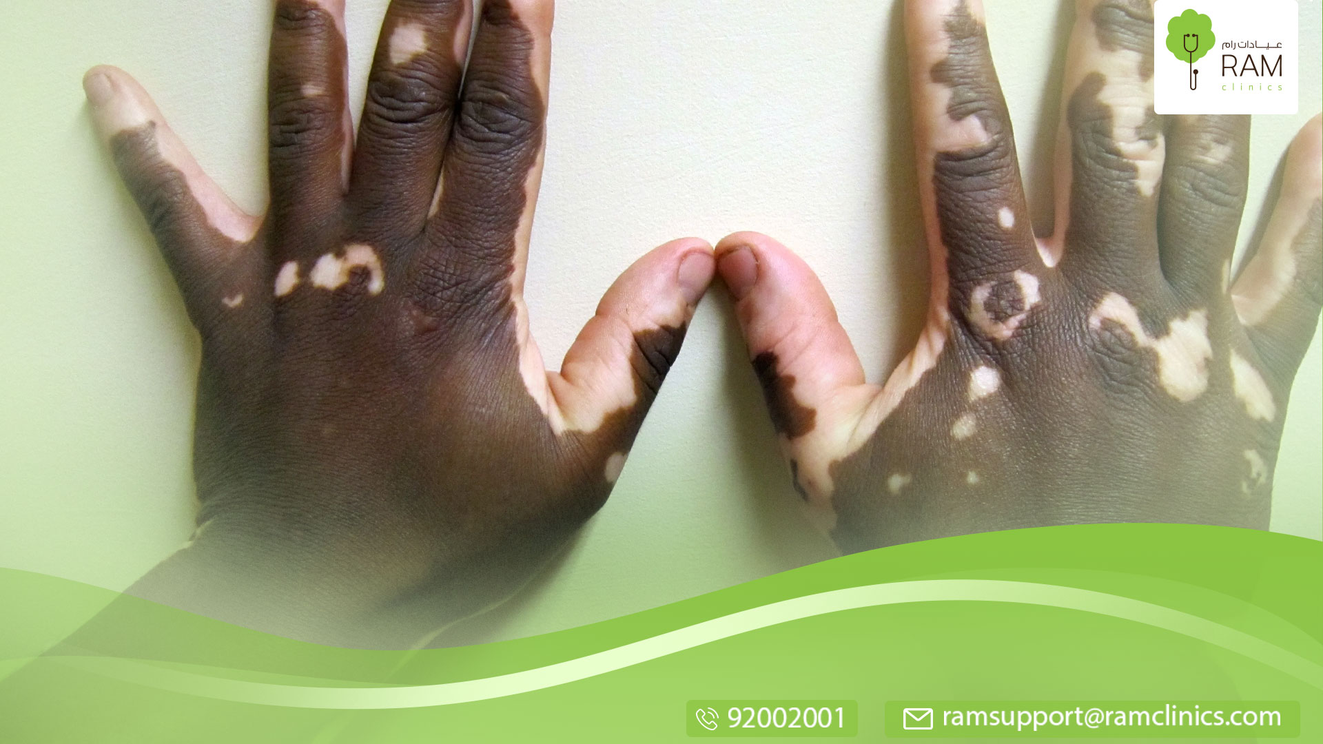 ما هو مرض البهاق الأسود