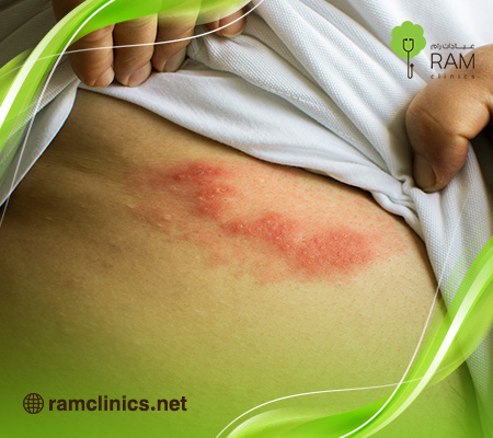 علاج-الحزام-الناري